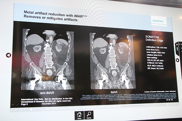 金属アーチファクト低減技術iMARによる臨床画像（人工骨頭）