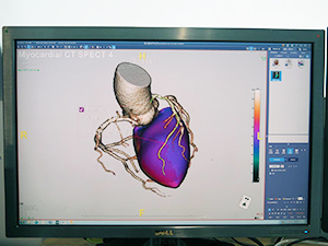 CTとSPECTのフュージョンによるテリトリー解析