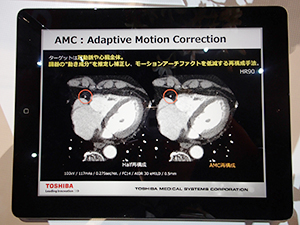 モーションアーチファクト軽減するAdaptive Motion Correction