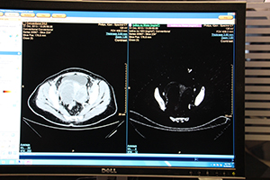 卵巣嚢胞症例。造影CT画像で卵巣内に高信号が認められた。Spectral解析では，造影剤（白）ではなく水（黒）であると鑑別でき，確定診断が可能であった。