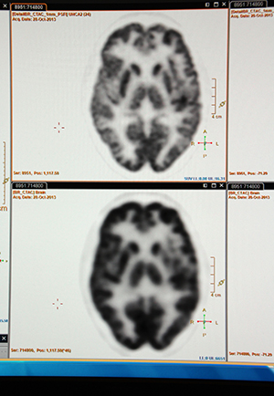 同一症例のデジタルPET/CT画像（上）とアナログPET/CT画像（下）