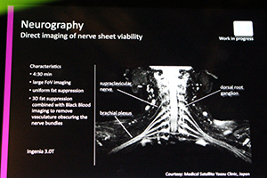 高分解能に神経鞘を描出する“Neurography”