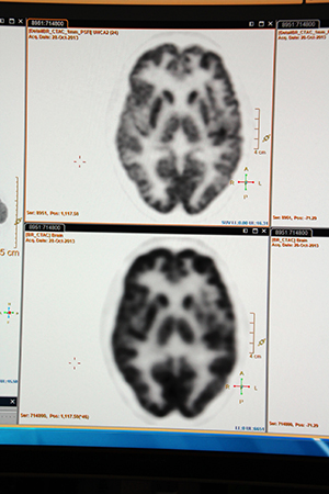 解像度が向上したデジタルPET/CT「Vereos PET/CT」の臨床画像（上）