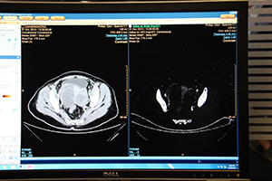 嚢胞と腫瘍の鑑別が可能になるスペクトラルCT「IQon Spectral CT」