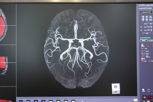 頭部MRA抽出機能：脳全体の抽出