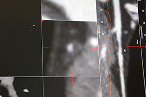 冠動脈サブトラクションにより，内腔境界の視認性が向上（CT冠動脈比較解析）