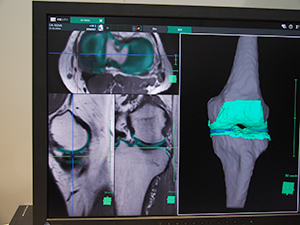 「SYNAPSE VINCENT」の変形性膝関節症の診断・治療支援アプリケーション（W.I.P.）