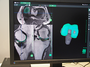 再生医療の算定条件である“軟骨欠損面積が4cm2以上”を簡単に計測可能
