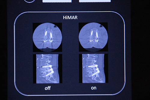金属アーチファクト抑制技術「HiMAR」の適用前（左），適用後（右）