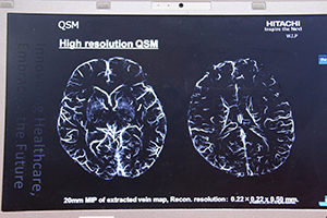 高画質化が可能なQSMでは脳表の静脈も明瞭に描出される。（W.I.P.）