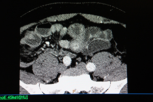 神経内分泌腫瘍（NET）症例の通常画像。大腸に複数の造影効果が認められる。