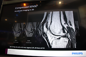 3Dも含め短時間スキャンを可能にする“Compressed SENSE”