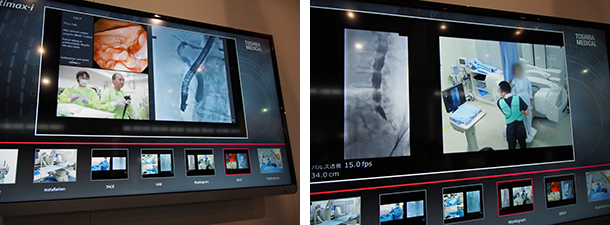 Ultimax-iによるさまざまな手技をビデオで紹介。ERCP（左）と整形外科のミエログラフィ（右）の様子