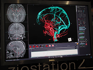 1相撮影で脳動静脈の分離を可能にする「脳動静脈分離」