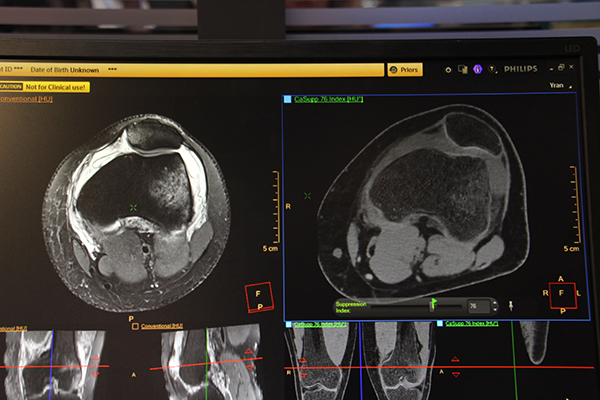 Calcium Suppression画像（右）では，MR画像（左）と同じように骨挫傷の描出が可能