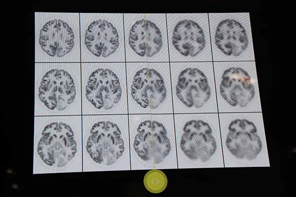 Vereos PET/CT（左）とアナログPET/CT（右）の画像比較