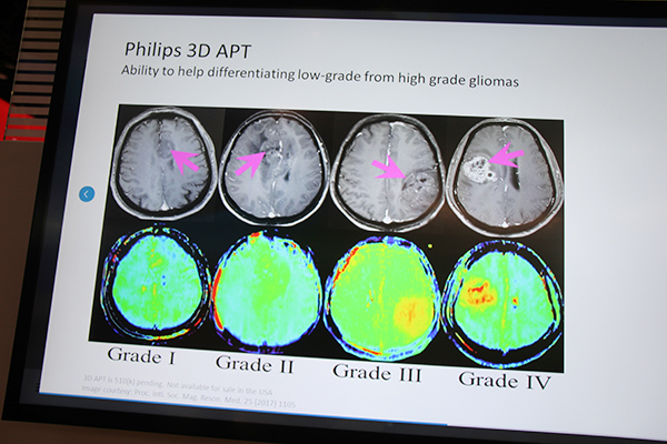 カラーマップで脳腫瘍のグレードを鑑別可能な“3D APT”