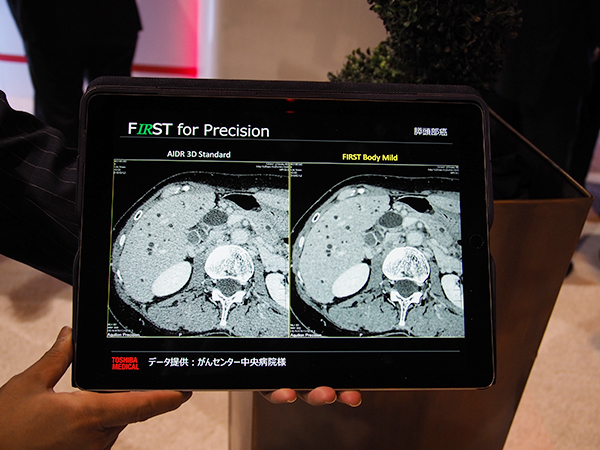 Aquilion Precisionでの腹部の膵頭部がんの画像。左がAIDR 3D Standard，右がFIRST BODY Mildによる再構成。FIRSTでは，画像全体のノイズを低減し低コントラスト領域や臓器の輪郭の描出能が向上。