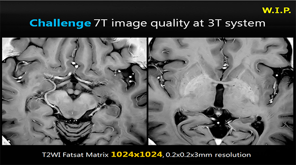 3T MRIで7Tに匹敵する画質を実現する超高分解能技術の開発をスタート（W.I.P.）
