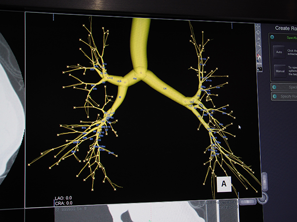 三次元医療画像認識技術“RealiZe”で末梢の気管支までラベリング