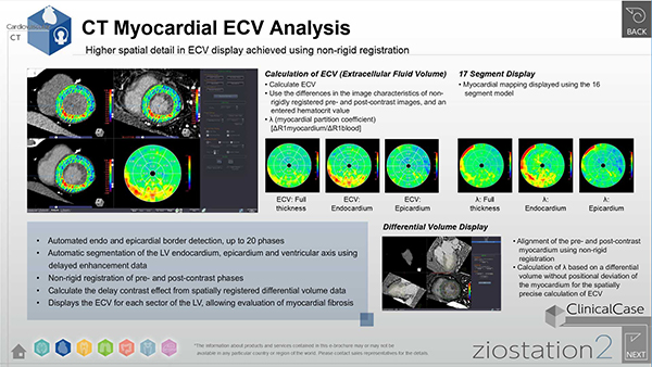 CT心筋ECV解析