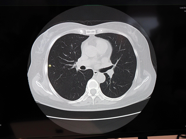 エルピクセルが開発する胸部CT画像の病変検出技術