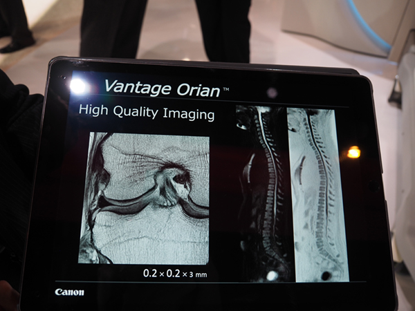Vantage Orianでの脊椎のディフュージョン画像
