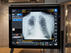 気胸を検出して診療を支援する“Critical Care Suite”（FDA未承認）