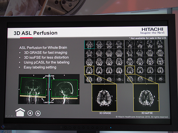 高速撮像と高画質撮像に対応する“3D ASL Perfusion”