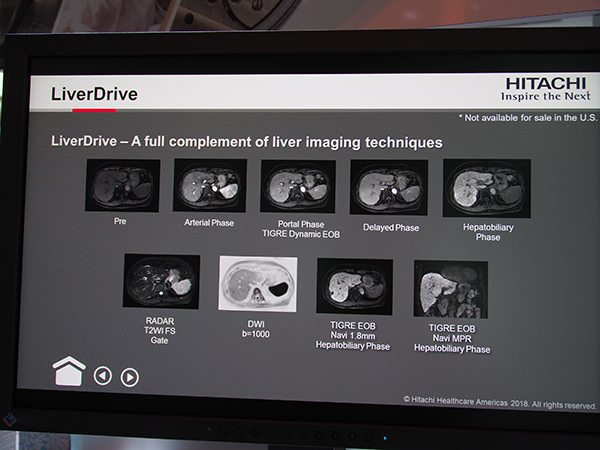 一連の肝臓EOB検査を自然呼吸下で撮像可能な“LiverDrive”