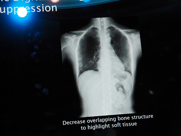 Bone Suppression（肋骨減弱）処理を施した動画像では，腫瘤の形状を把握しやすい。