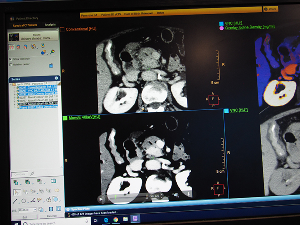 膵臓がん症例：通常画像（120kVp，上）とMonoE（40keV，下）