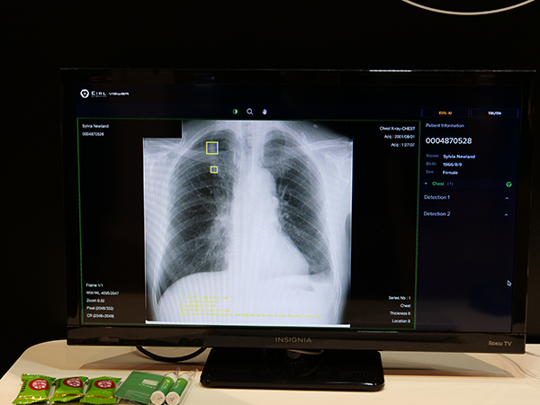 日本での製品化を進めている胸部単純X線写真の結節検出アルゴリズム