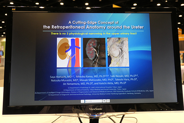 “There is No 3 Physiological Narrowings in the Upper Urinary Tract: A Cutting-Edge Concept of the Retroperitoneal Anatomy Around the Ureter”