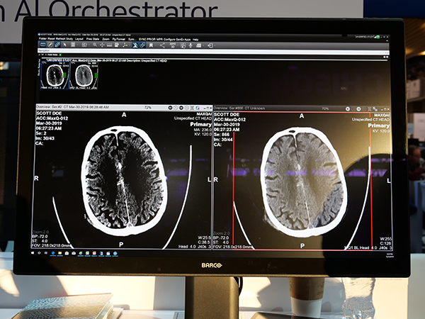 「Universal Viewer」で非造影CTの出血検出アルゴリズムの解析結果を表示（薬機法未承認）