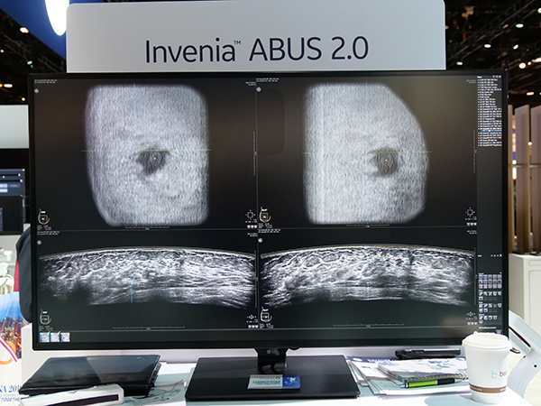 「Invenia ABUS 2.0」では画質改善で診断能が向上