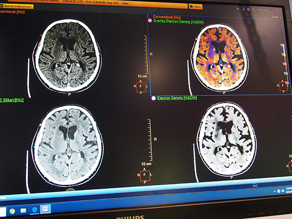 Electron Density（右下）による脳梗塞の明瞭化。右上は通常画像とElectron Densityカラーの重ね合わせ。