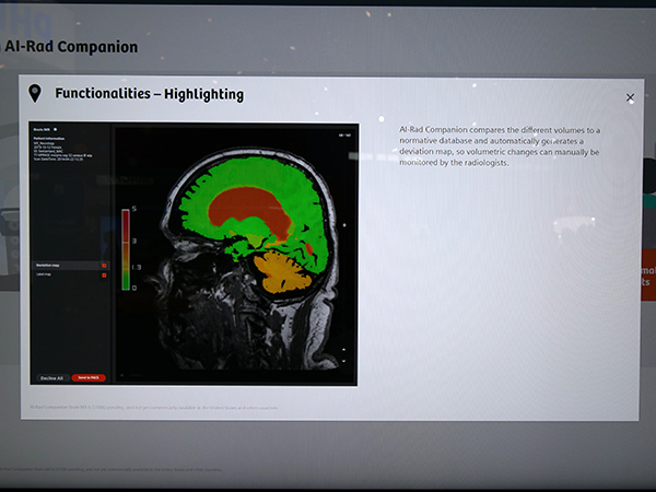 頭部MRIでの脳の各部位のボリューム計測（薬機法未承認）