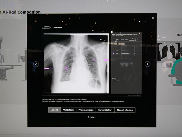 胸部単純X線写真の病変検出（薬機法未承認）