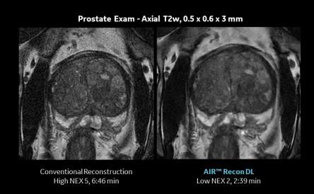 日本でも発売されたディープラーニング画像再構成技術“AIR Recon DL”