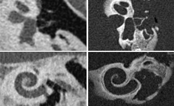 従来CT（左）とNAEOTOM Alpha（右）によるあぶみ骨と蝸牛の描出