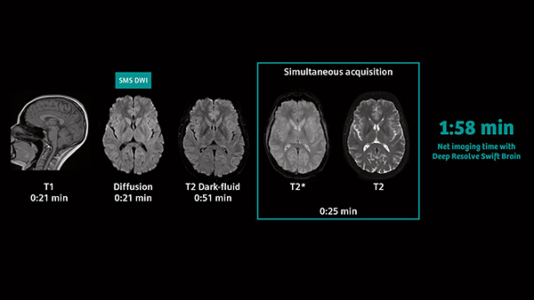 脳卒中向け検査パッケージ“Deep Resolve Swift Brain”