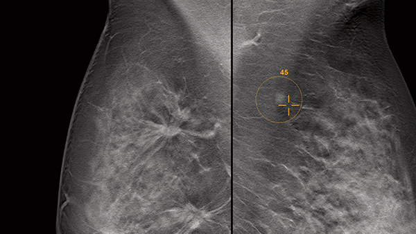 AI技術で病変をROIで囲み悪性度をスコア化する「syngo. Breast Care」（薬機法未承認）