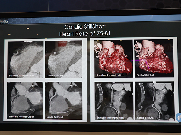 冠動脈の従来画像（各画像左）とCardio StillShotを適用した画像（同右）。モーションアーチファクトが低減され，冠動脈をしっかりと評価できる。
