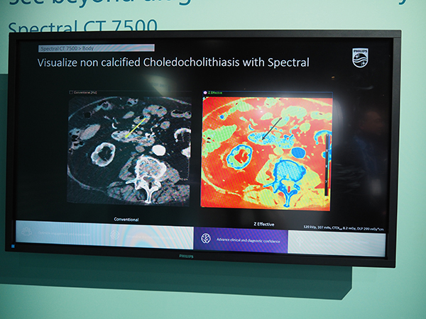 従来の画像（左）に対し，スペクトラルCT画像（右）では視認性が大幅に向上している。