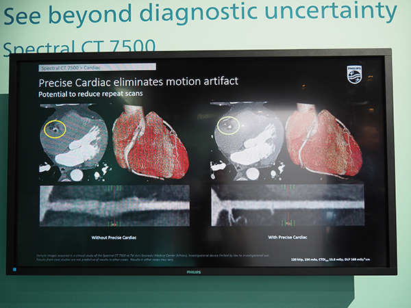 心臓モーションアーチファクト補正技術“Precise Cardiac”により，心臓のより高精細な画像が取得できる。