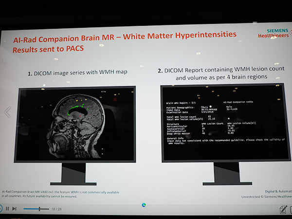 灰白質の高信号領域を自動抽出する機能が備わった「AI-Rad Companion Brain MR」