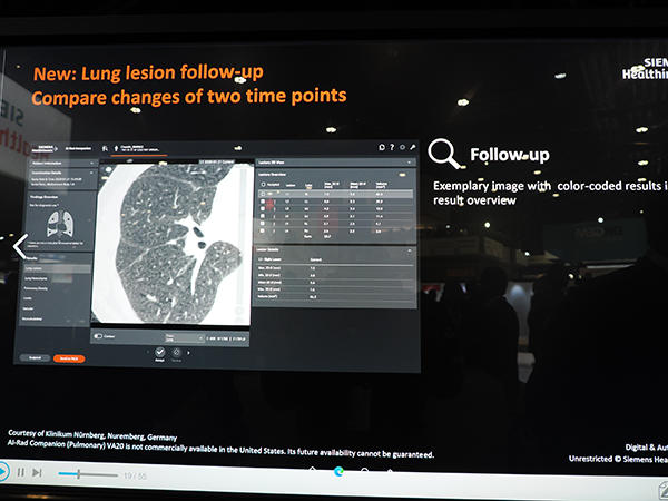 「AI-Rad Companion Chest CT」で新たに可能となった過去画像との比較評価