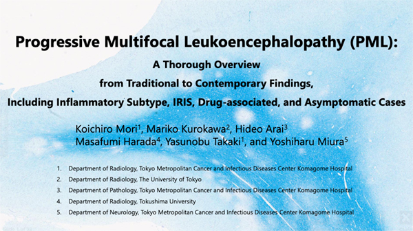 NREE-21 Progressive Multifocal Leukoencephalopathy (PML): A Thorough Overview from Traditional to Contemporary Findings, Including Inflammatory Subtype, IRIS, Drug-associated, and Asymptomatic Cases 森　紘一朗 氏（がん・感染症センター都立駒込病院）ほか