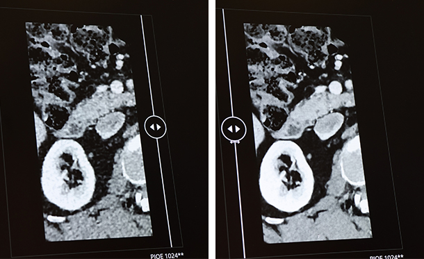 腹部においてもPIQEが適用可能になり，従来（左）に比べ1024マトリックスのPIQE画像（右）では，高分解能化とノイズ低減を実現
